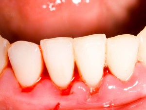 Bleeding-Gums