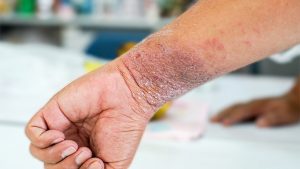 eczema