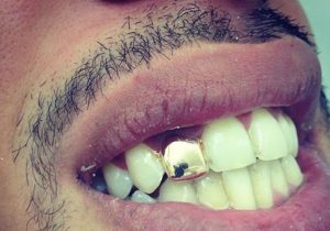 gold tooth